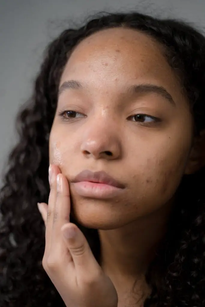 A lady with postpartum acne